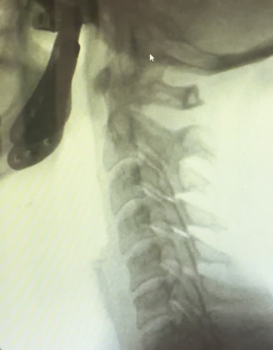 Lateral Digital Motion X-ray view of a cervical spine in profile