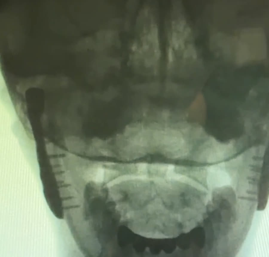 Open-mouth Digital Motion X-ray view of the top two cervical vertebrae