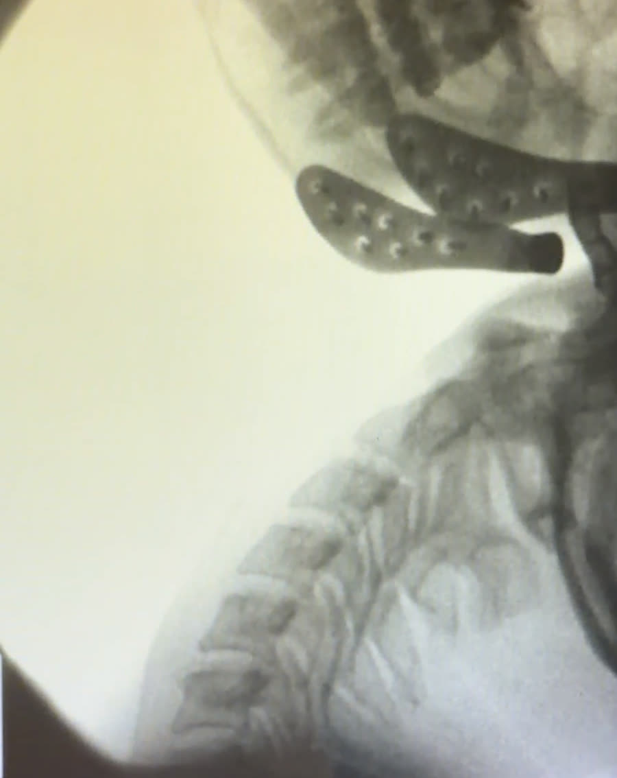 Close Digital Motion X-ray view of the upper cervical spine